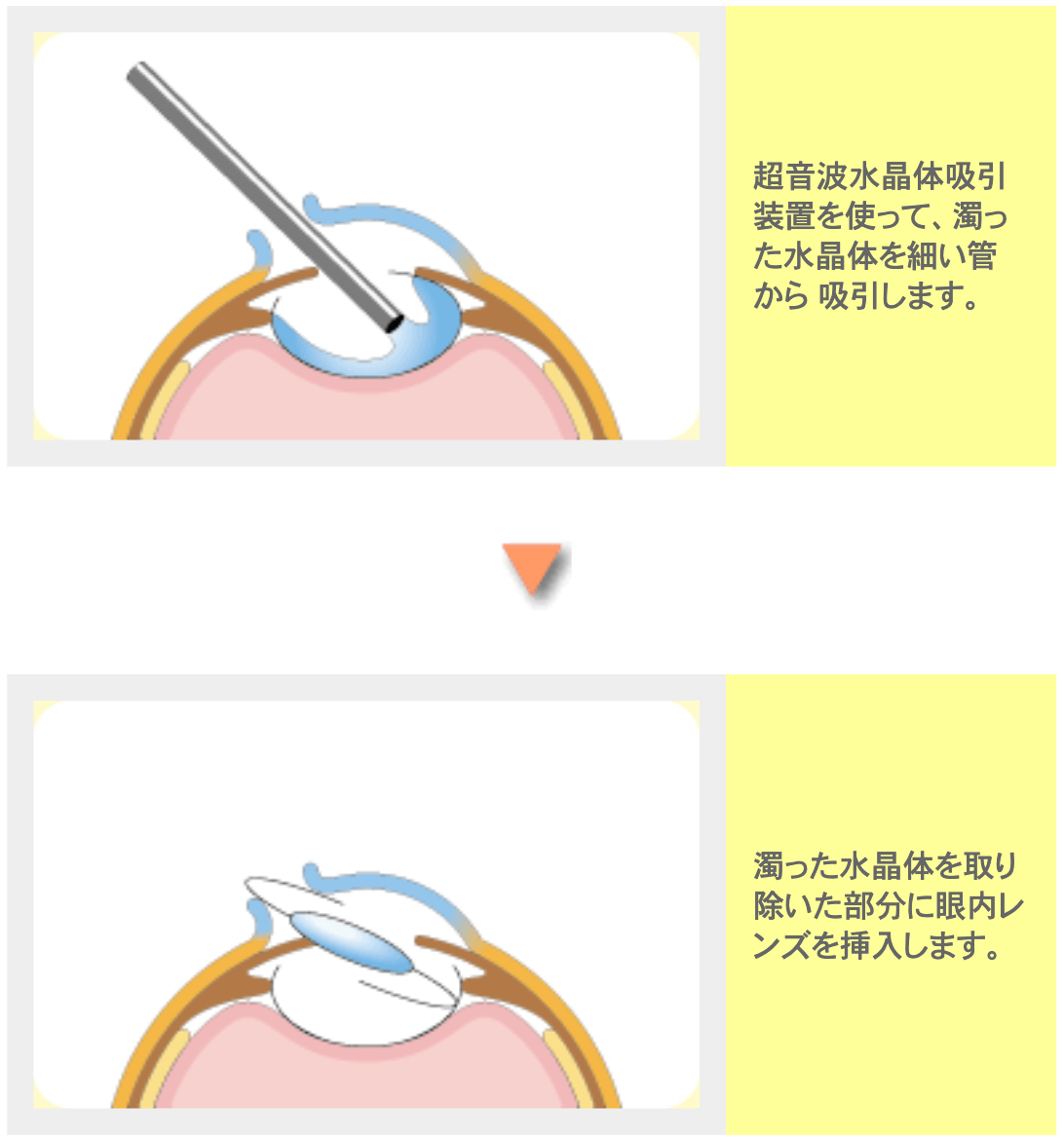 白内障手術