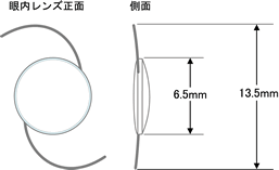 白内障眼内レンズ